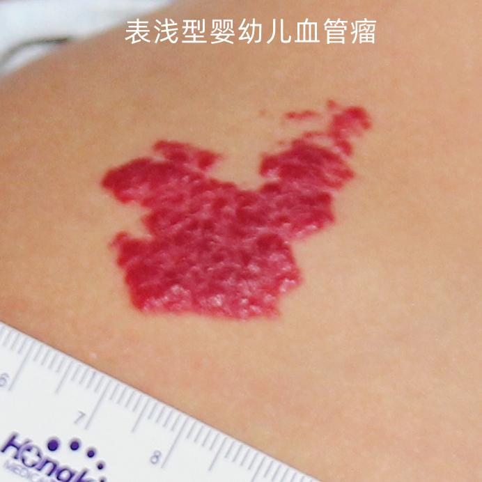 表浅型婴幼儿血管瘤的外用药治疗:马来酸噻吗洛尔凝胶或滴眼液的使用 - 知乎