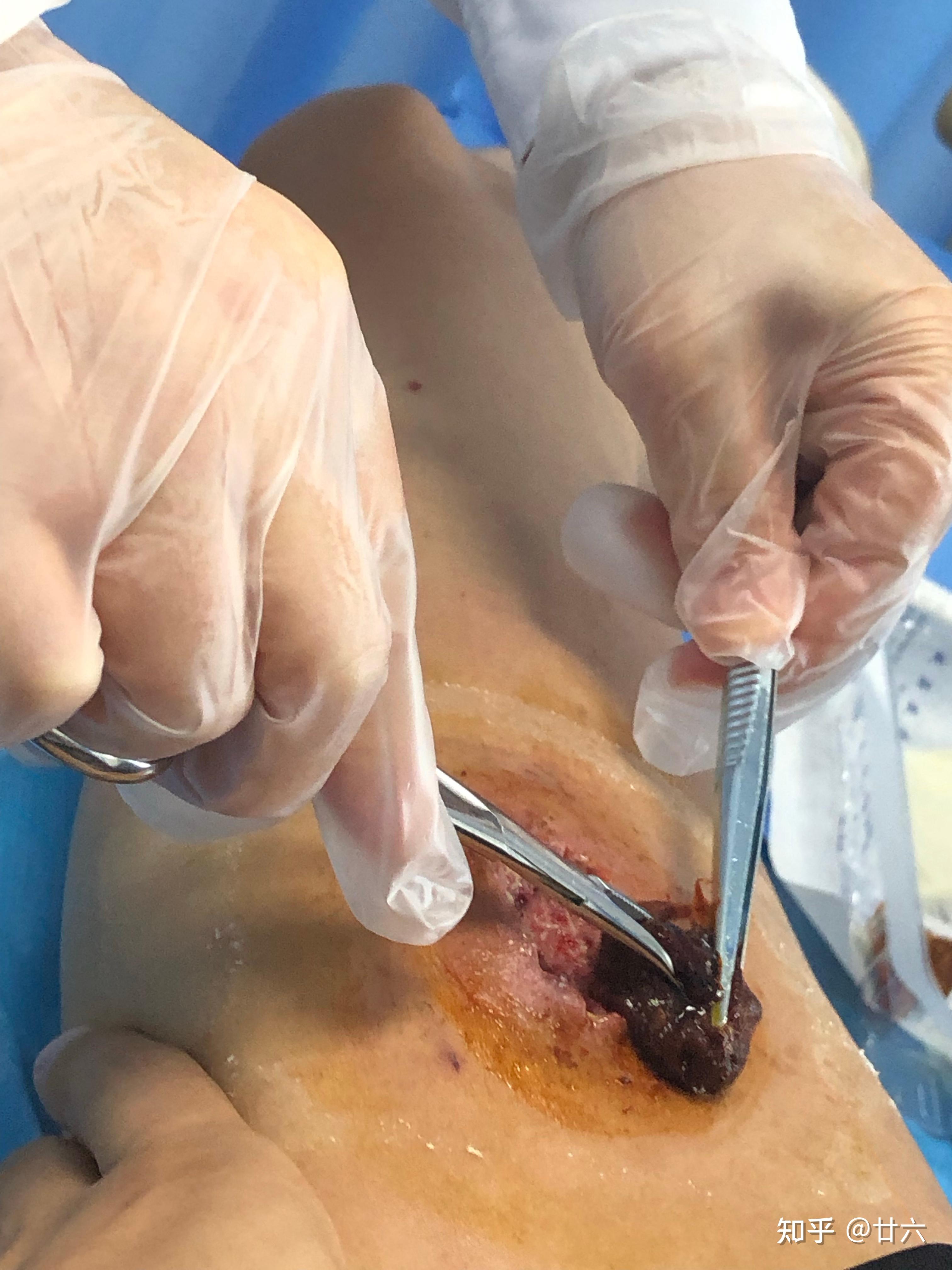 人体的火疖子 (化脓性毛囊及毛囊深部周围组织的感染) 能有多大?