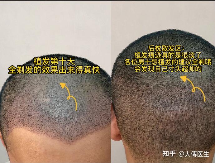 黑雾植发(一洗黑植物染发排名第一)