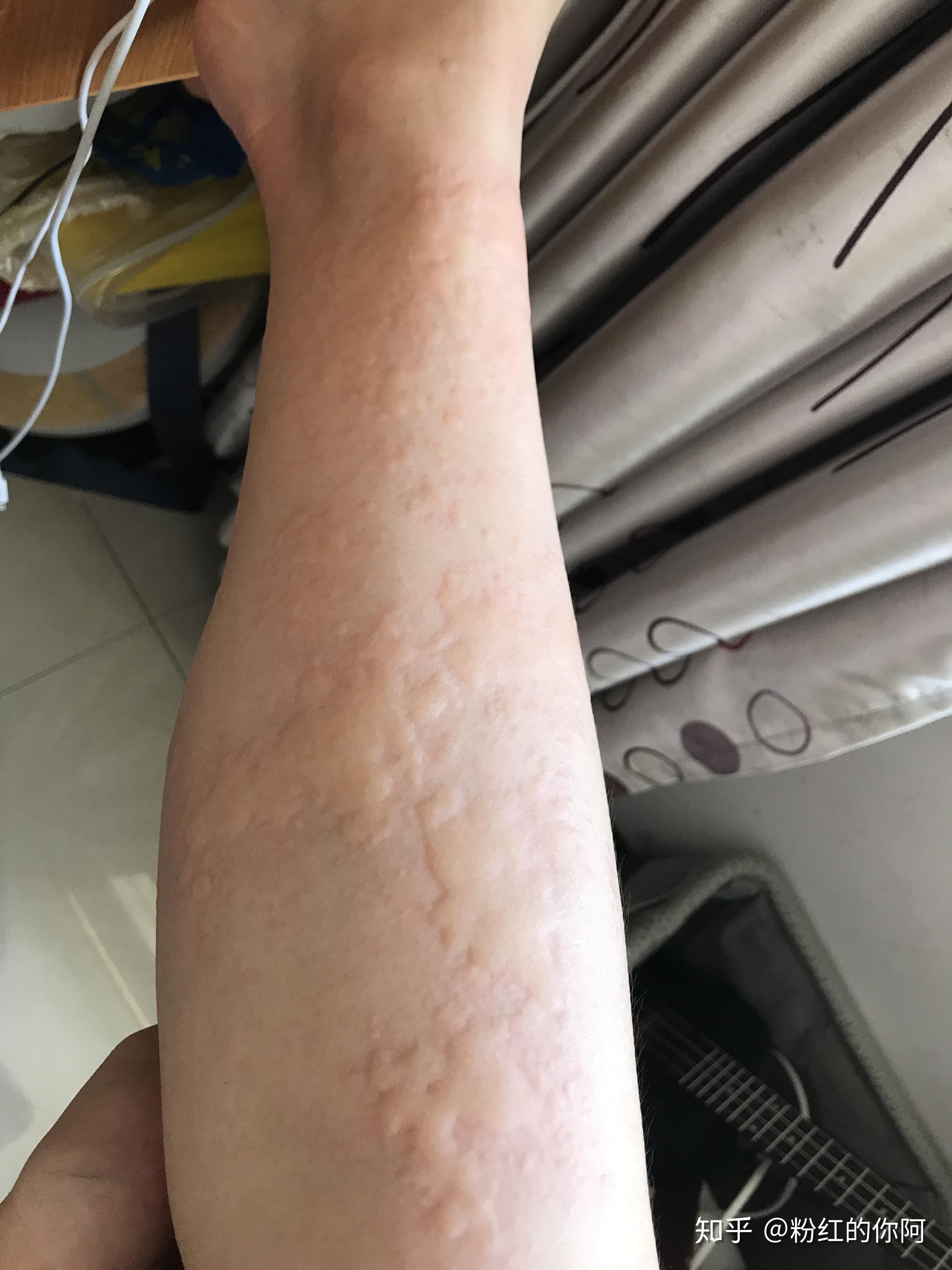 荨麻疹真的没办法根治吗