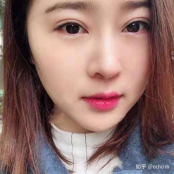 有哪些双眼皮修复手术成功案例? - 知乎