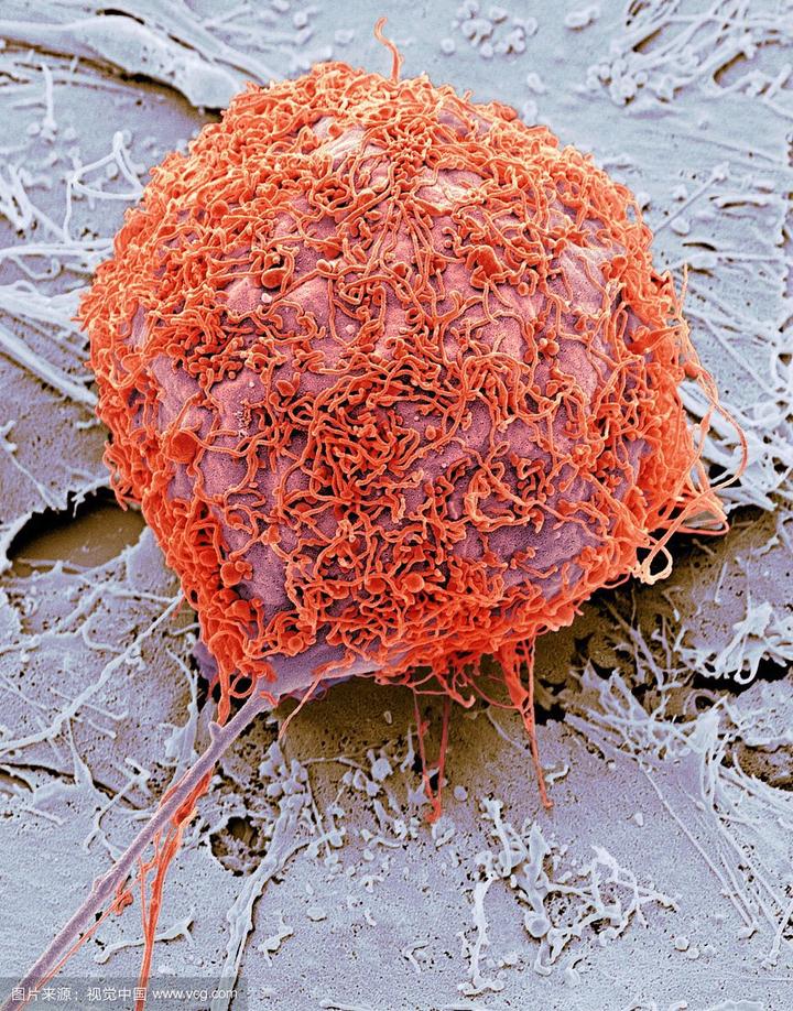 良性骨肿瘤恶性骨肿瘤治疗方法送给你