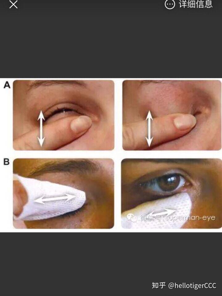 睑板腺堵塞造成干眼症,有什么方法治疗? - 知乎