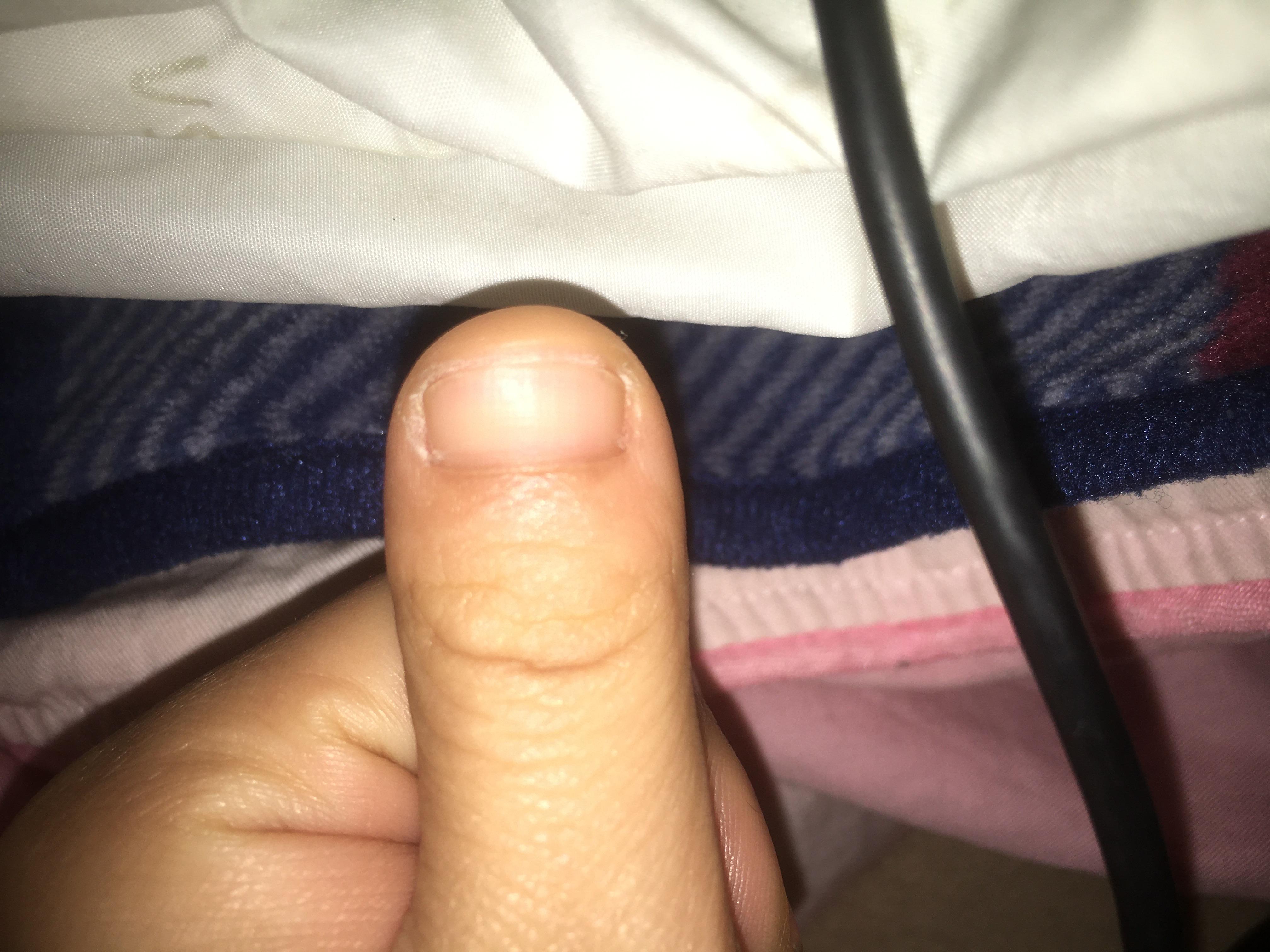 为什么我的大拇指又宽又短? 