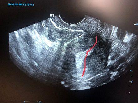 子宫前位和子宫后位是什么意思?