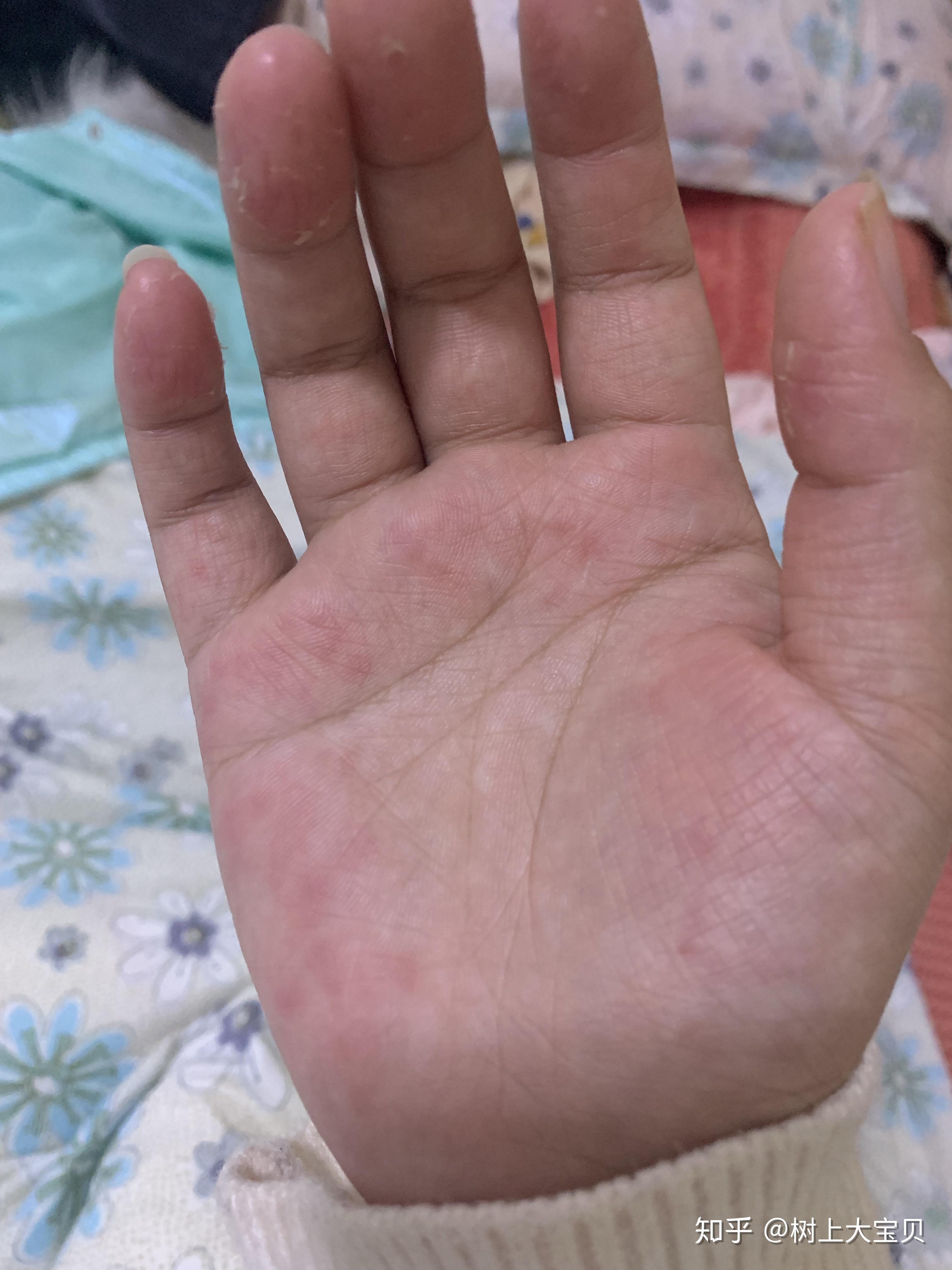 有对洗衣粉洗衣液过敏的人吗? - 知乎