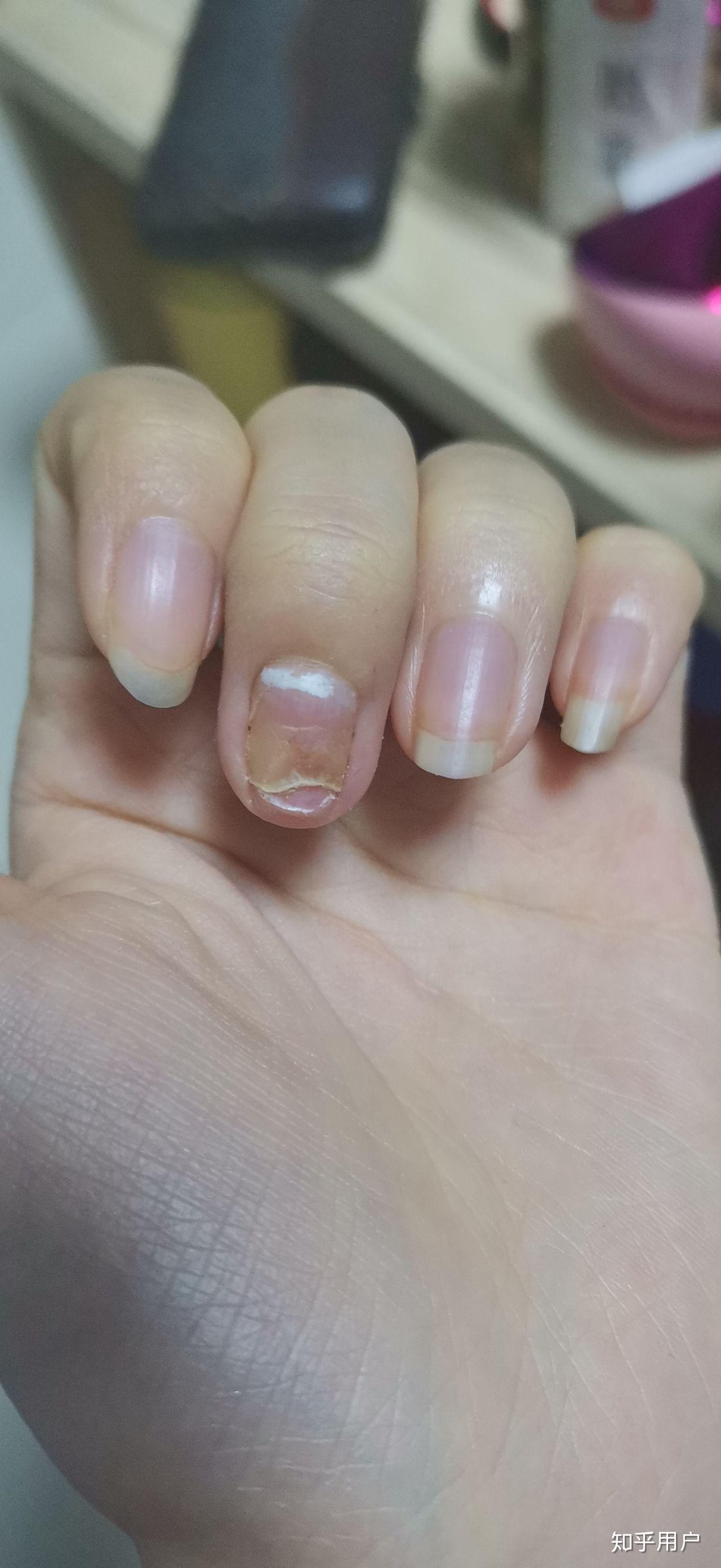 甲分离有六七年了从一个指甲慢慢发现到6个并且脚趾甲也开始空了每年4