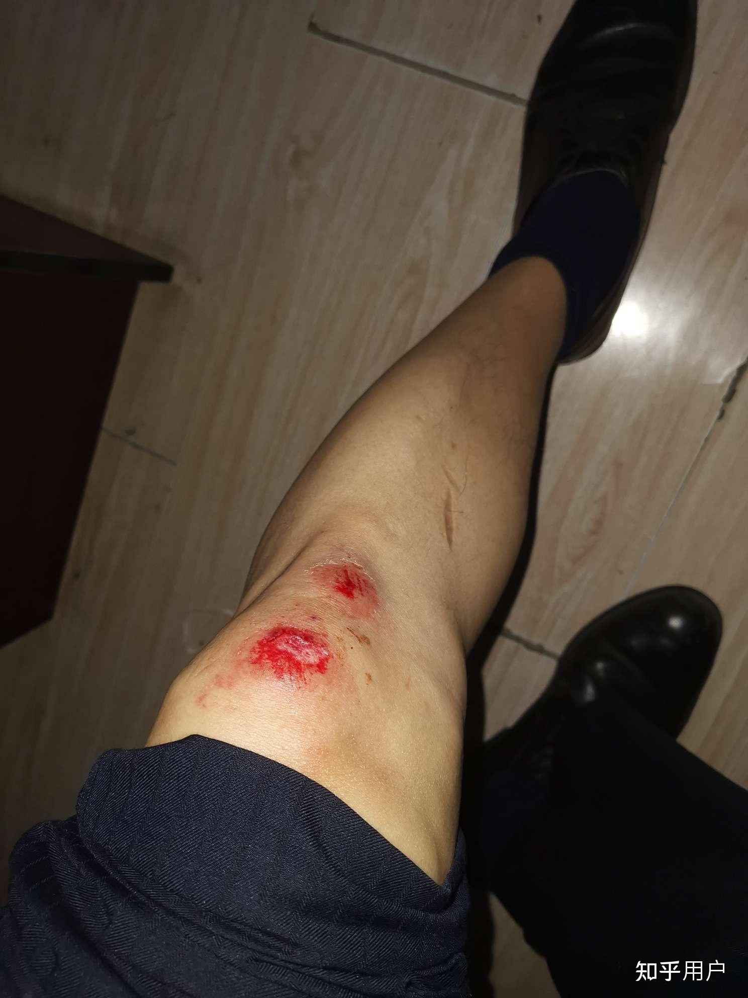 骑行摔车风险大,如何防护腿部受伤?需要佩戴护膝吗?