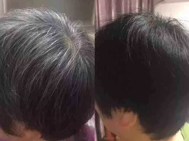 白发能改善吗?白发有什么类型? - 知乎