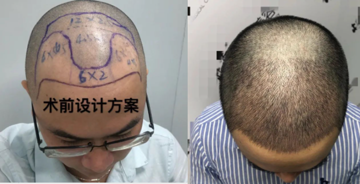 植发到底靠不靠谱?FUT还是FUE植发好?毛发种植到底要花多少钱? - 知乎
