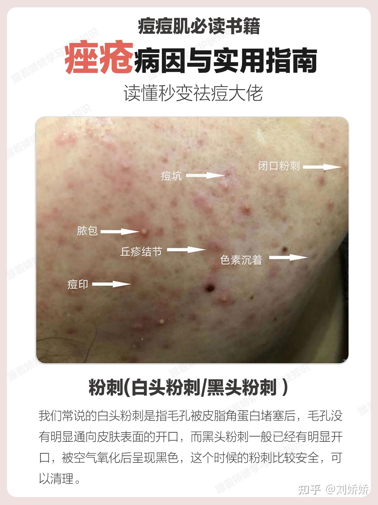 解读《痤疮病因与实用指南》-不同类型的痘痘不同处理方法,叫不出它们的名字的小伙伴都要仔细看! - 知乎