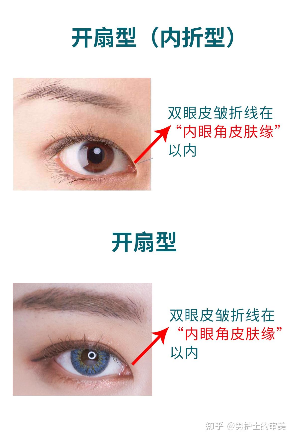 微创短切口双眼皮案例（56）-搜狐大视野-搜狐新闻