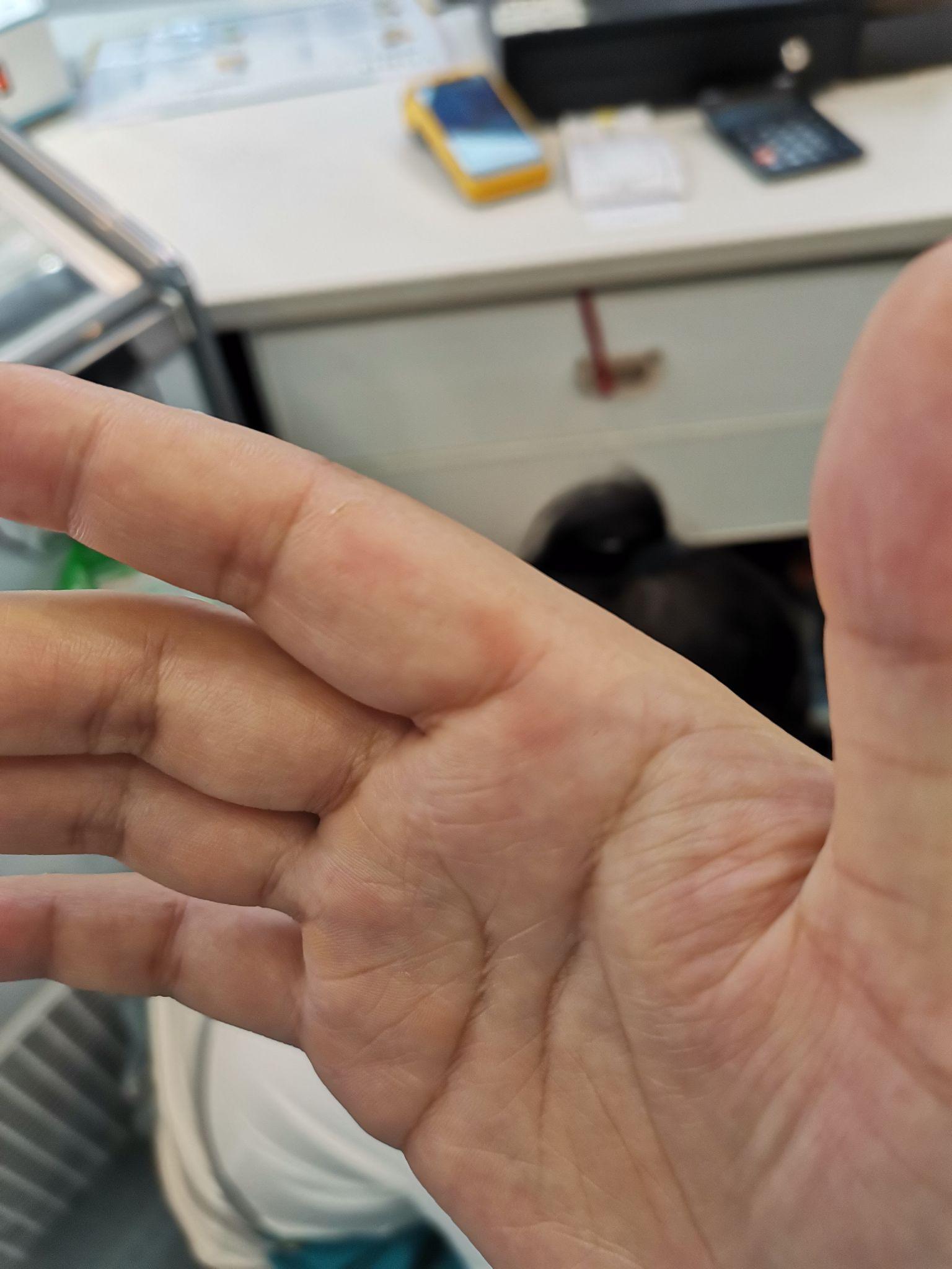 手掌突然淤青怎么回事