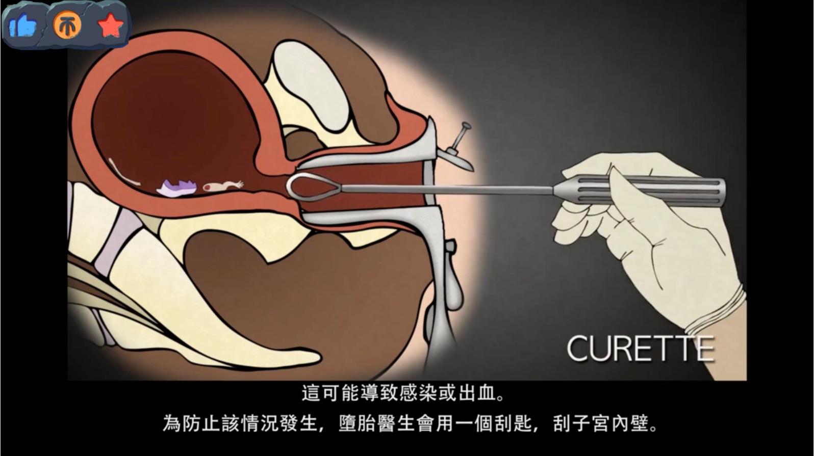 什么是刮宫手术? - 知乎