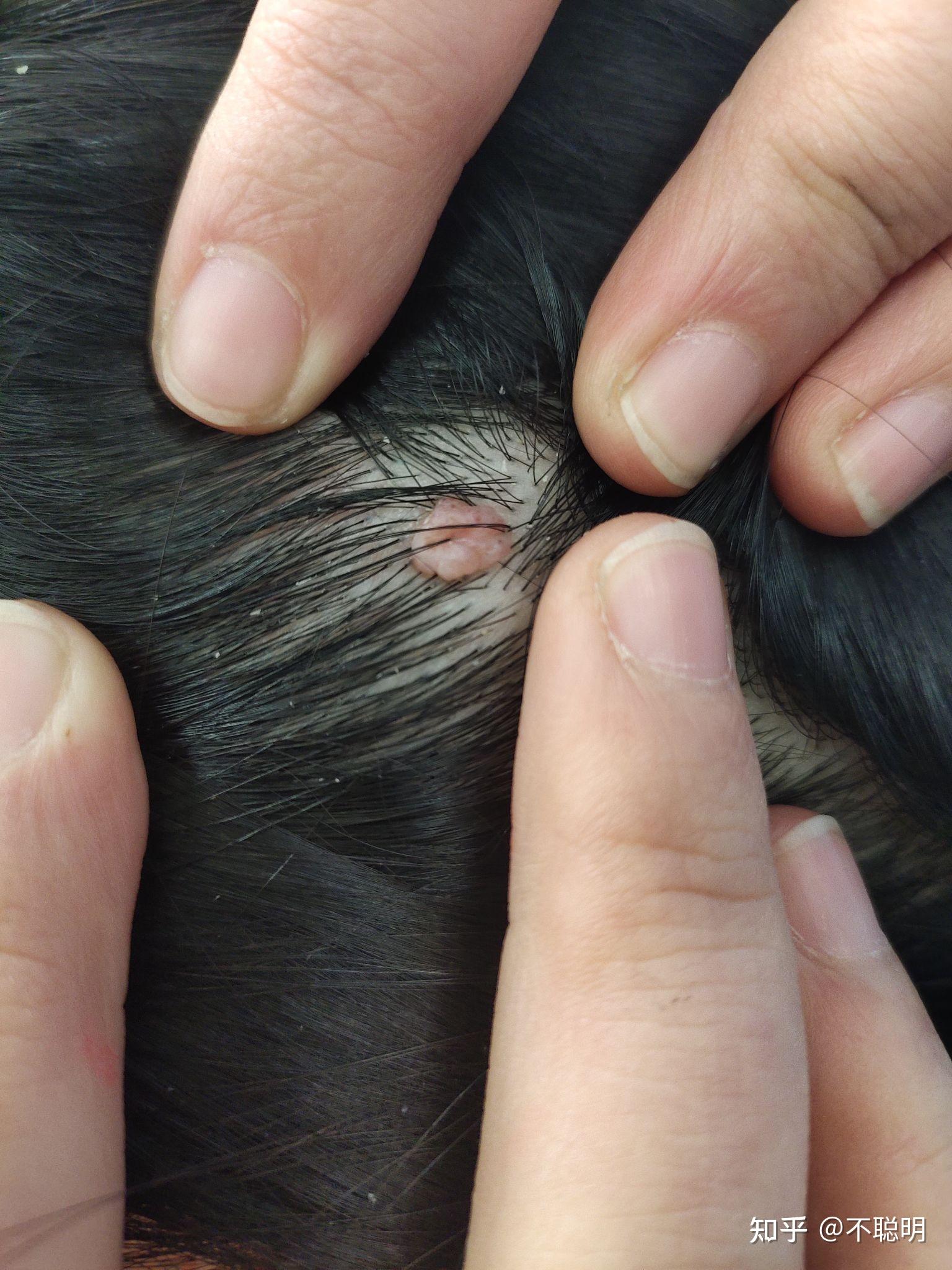 大家帮我看看这是瘊子还是痦子,长在头皮上的!谢谢啦? - 知乎