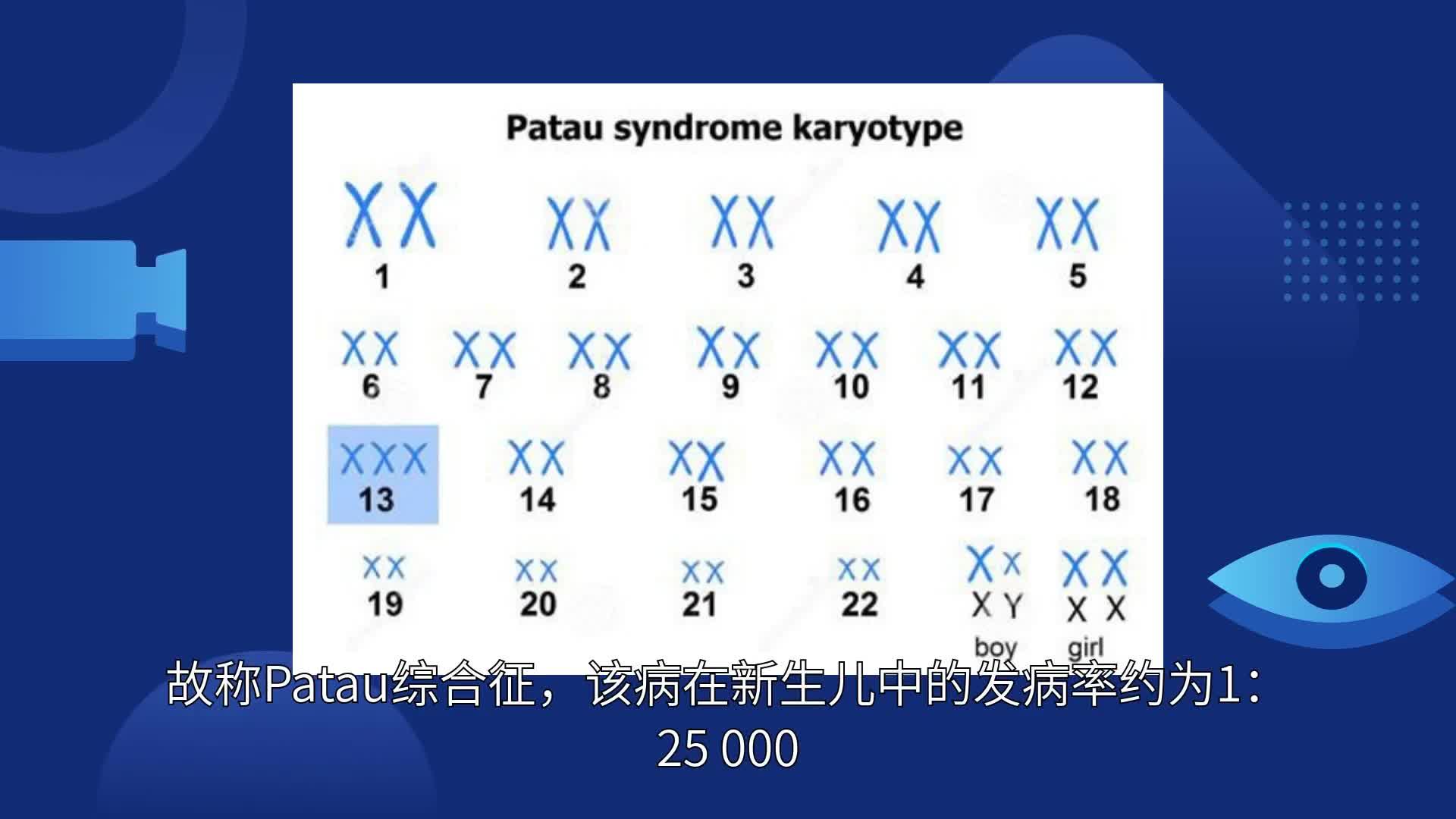 帕陶氏综合征是啥病啊发病率约为125000女性明显多于男性