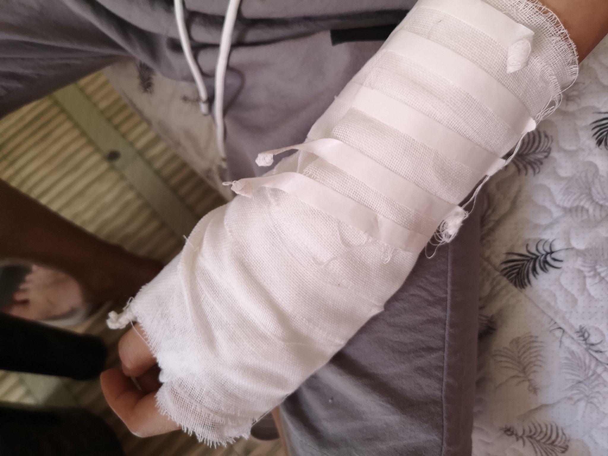 好朋友胳膊骨折了该怎么去嘲笑他?