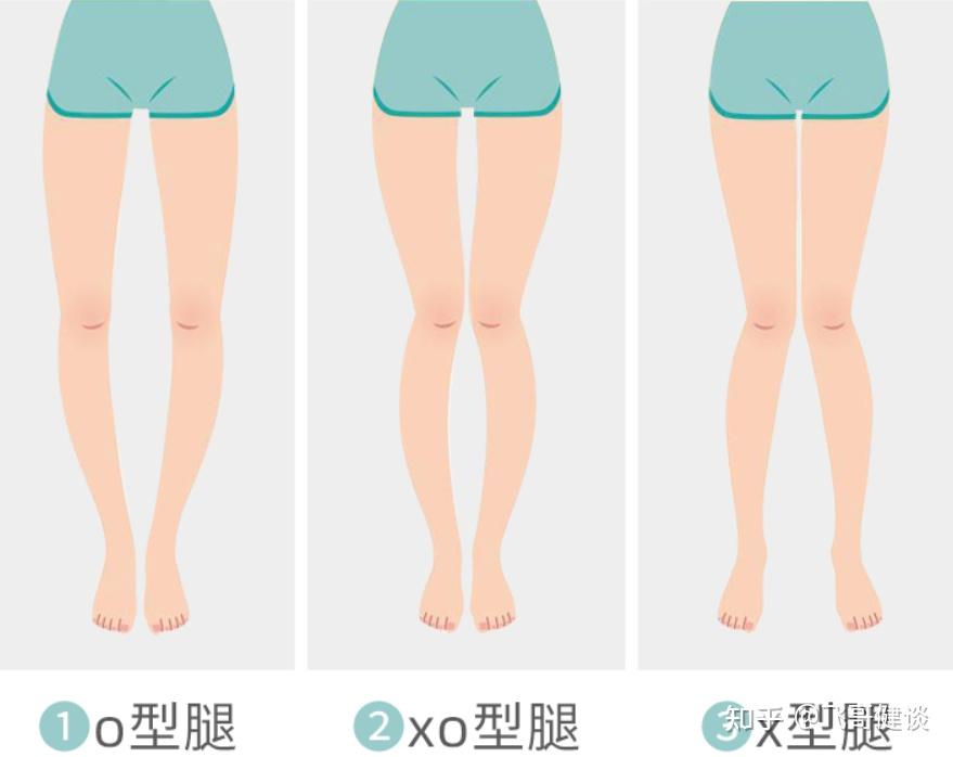 哪位大佬帮我看看我这是o型腿髋外旋 还是 髋内旋? - 知乎