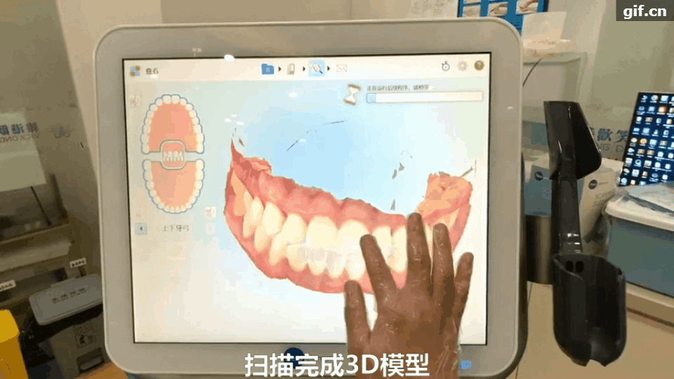 你不知道的iTero口扫仪-预见效果 - 知乎