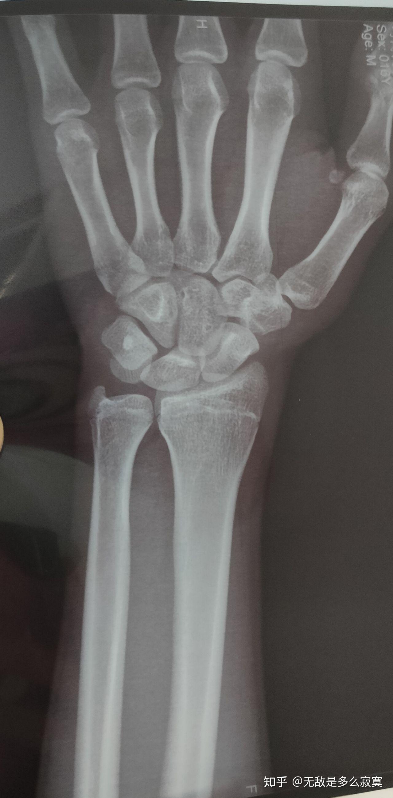 骨骺线接近闭合这么看