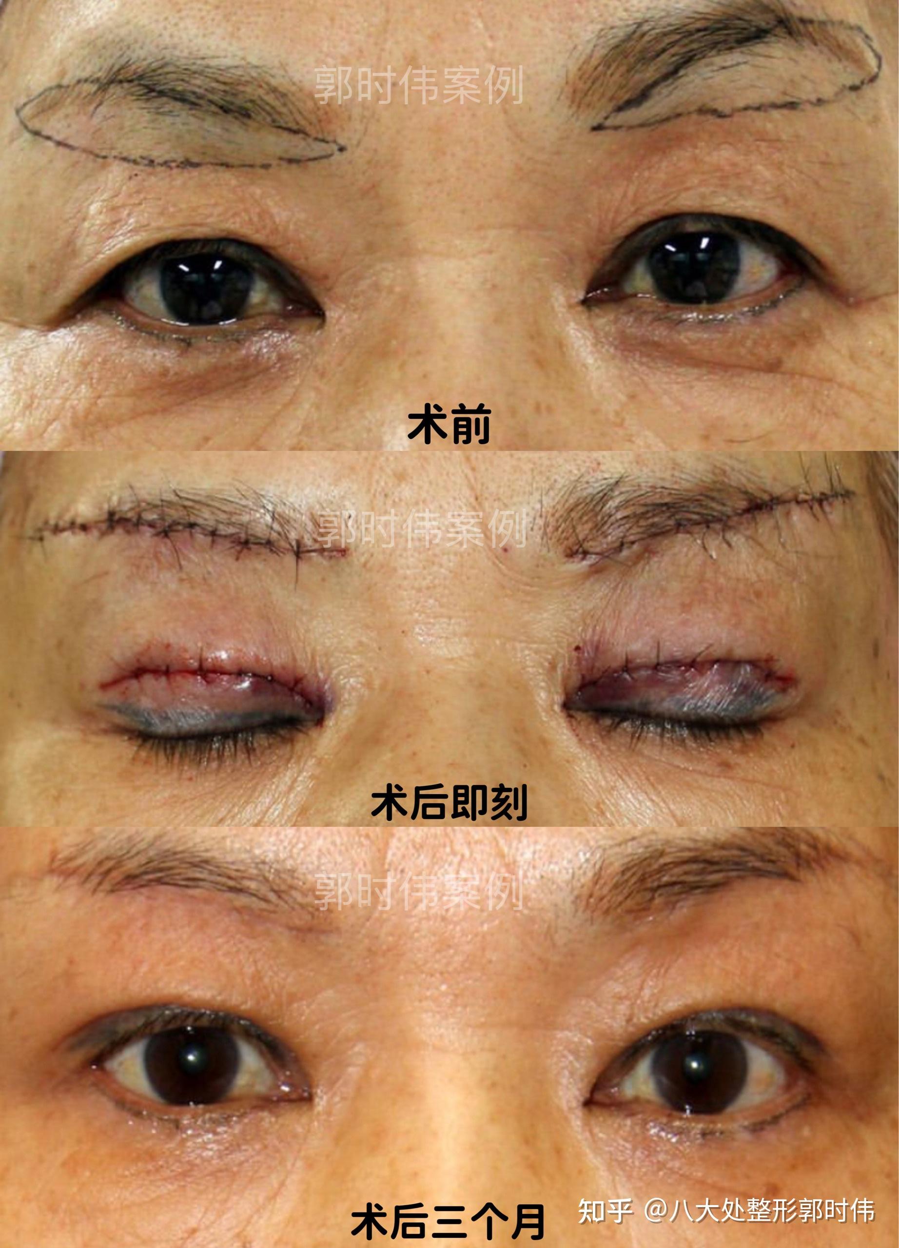 切眉(提眉)是一种什么体验? - 知乎