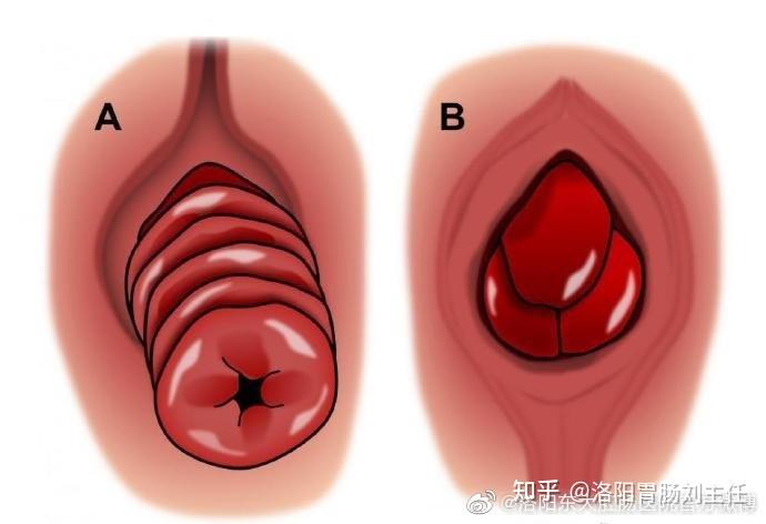 脱肛和痔疮的区别是什么救救我