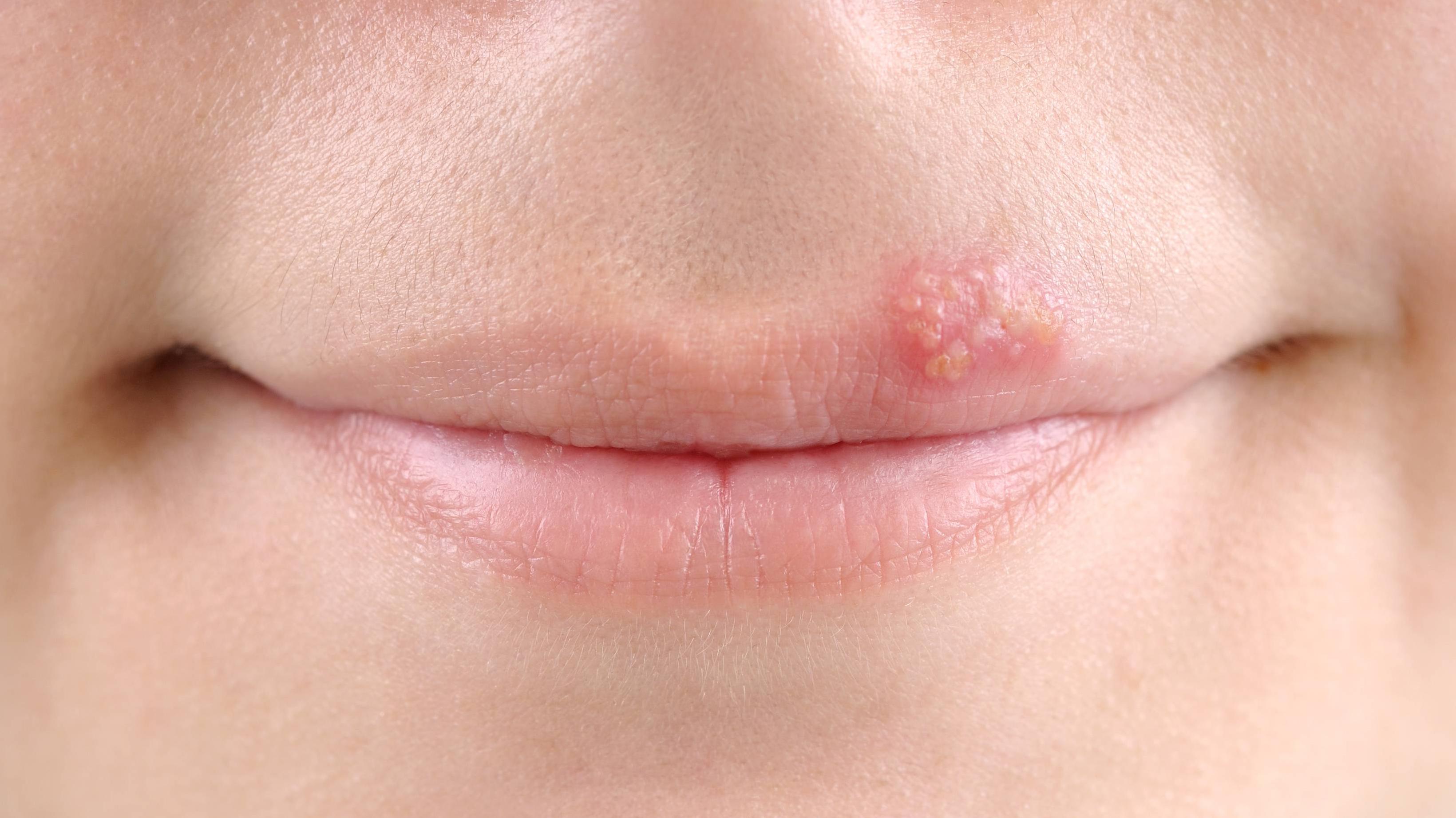 【配图】你的嘴唇为什么会起泡?