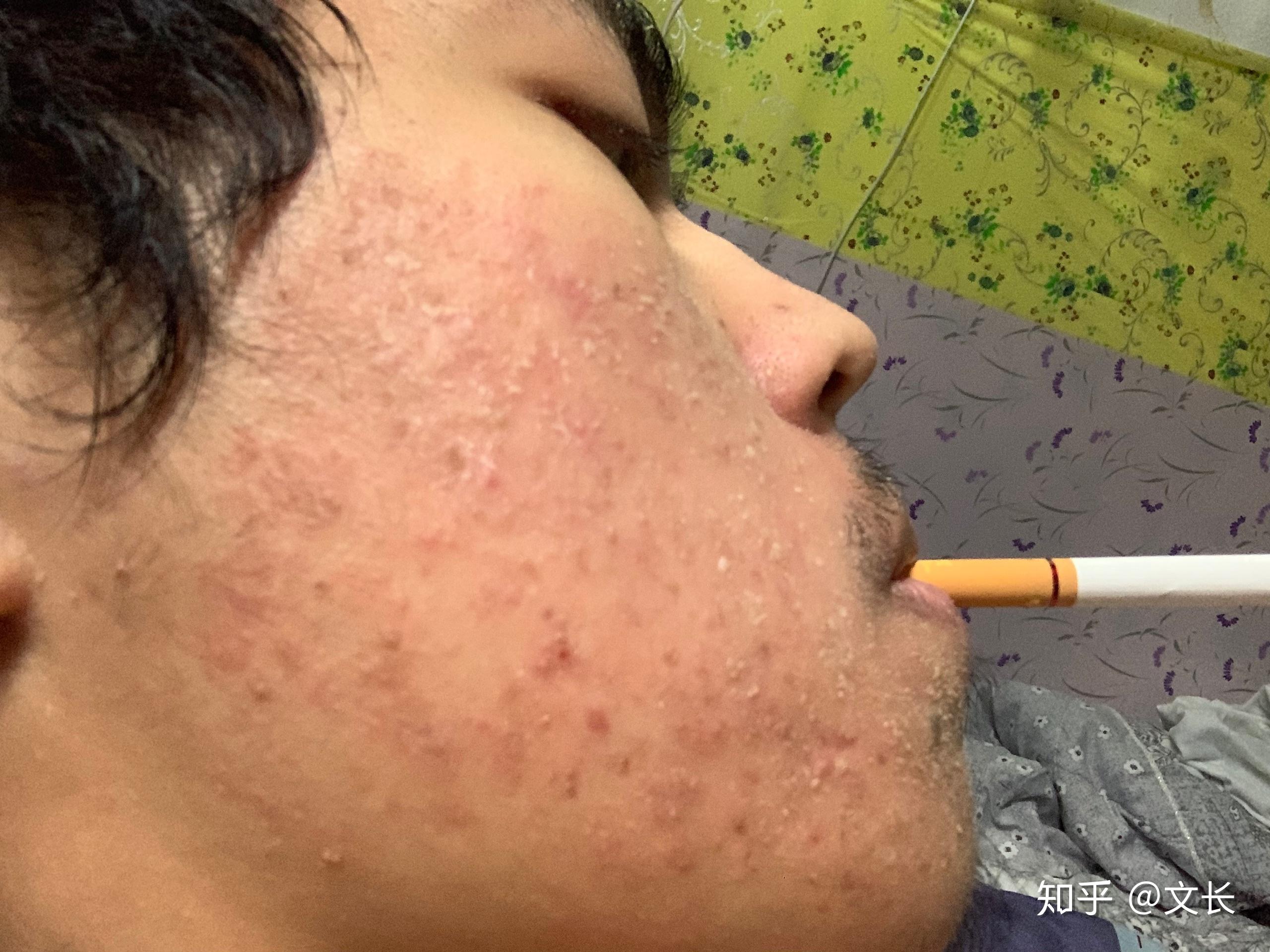 使用阿达帕林后,皮肤非常干燥脱皮,灼烧疼痛,而且脸特别红? - 知乎