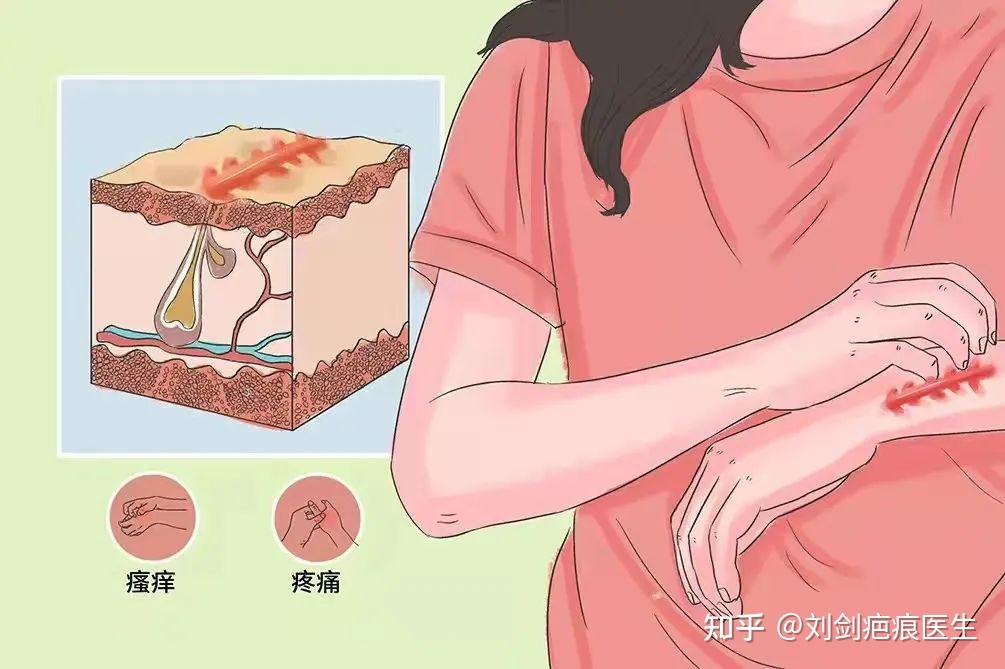 关于疤痕,你不得不知道的三个时期! - 知乎