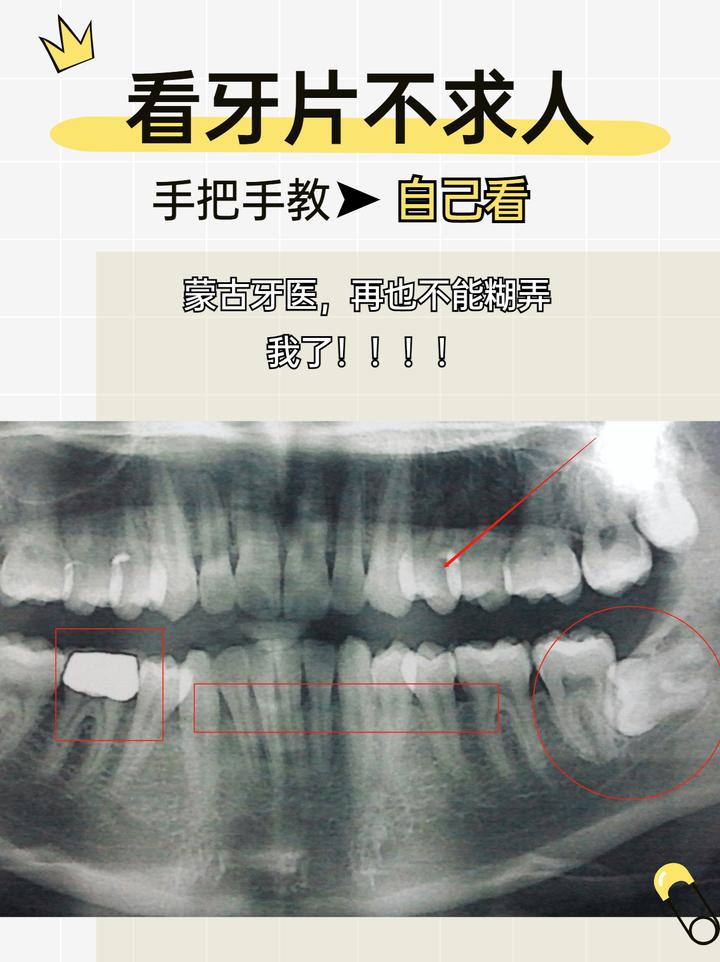 全景牙片怎么看图解图片