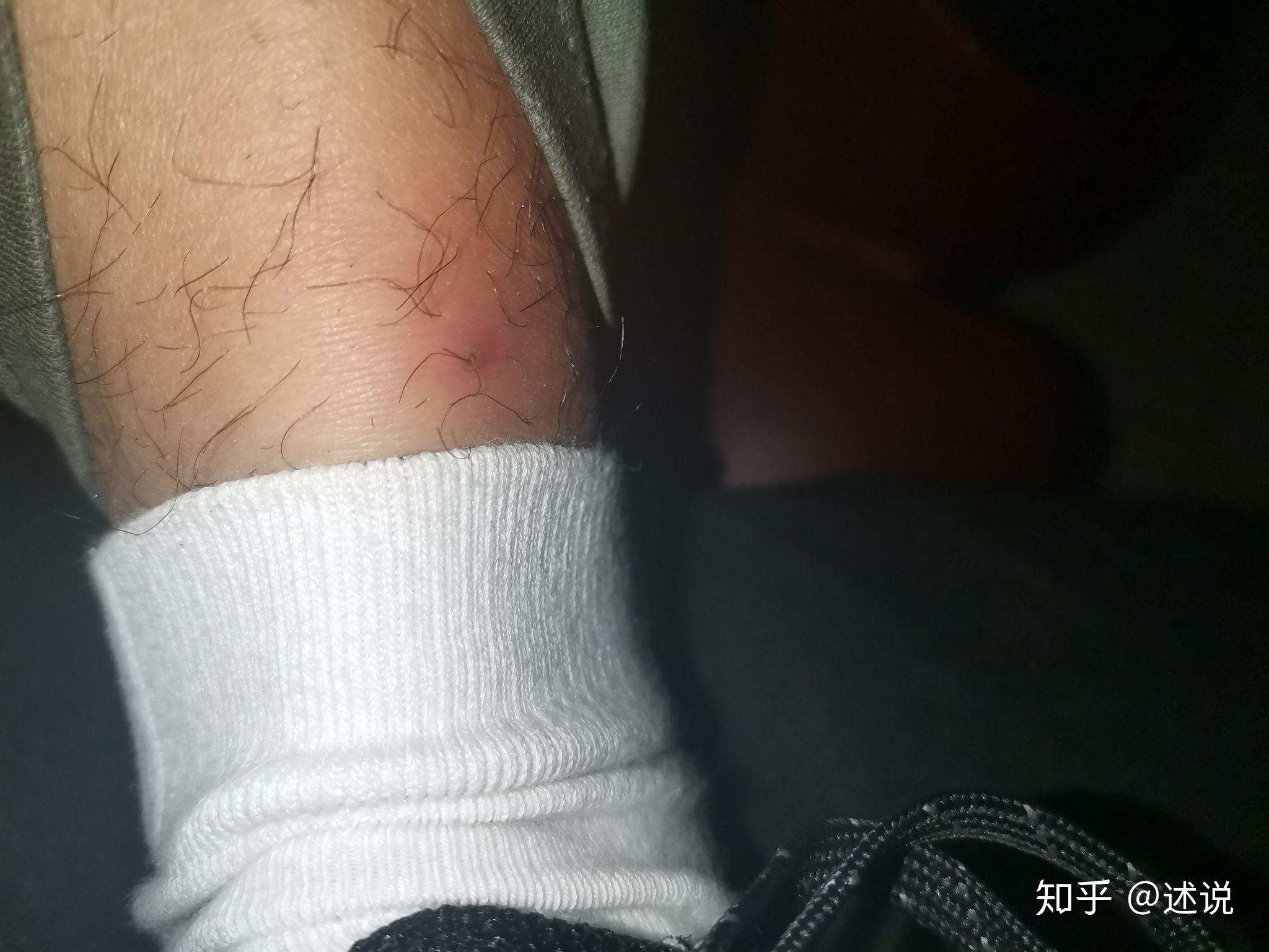 大腿上长了一个很大的脓包按上去有点痛什么原因怎么办