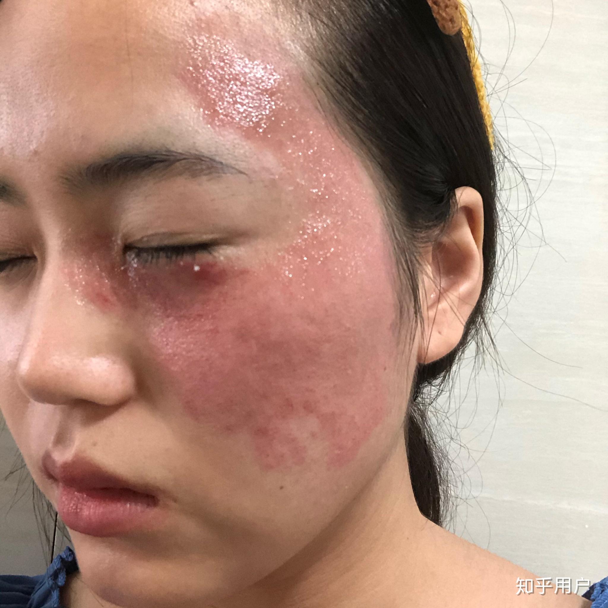 太田痣激光手术后几天可以见人呢