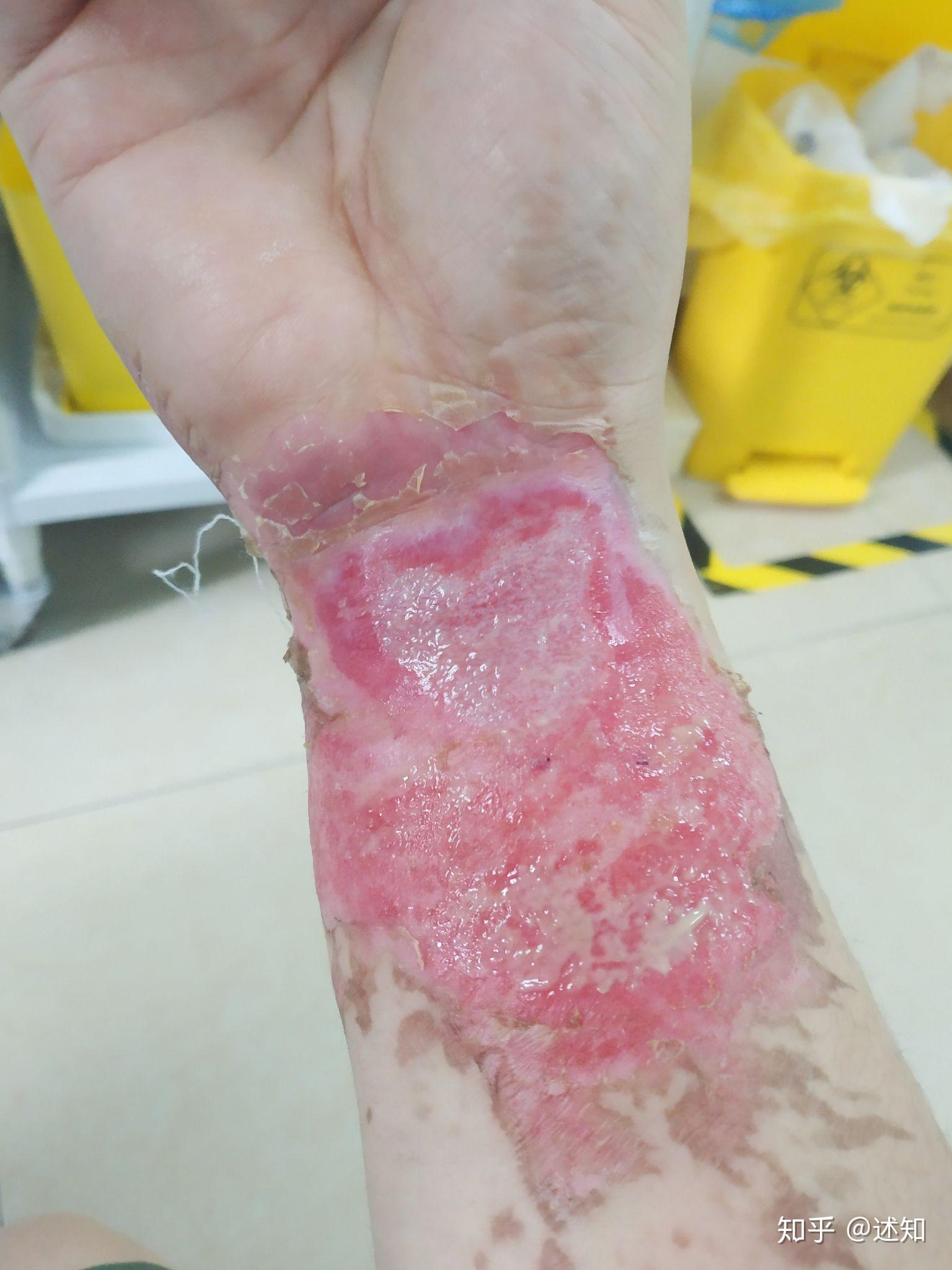 被油烫伤了怎么处理