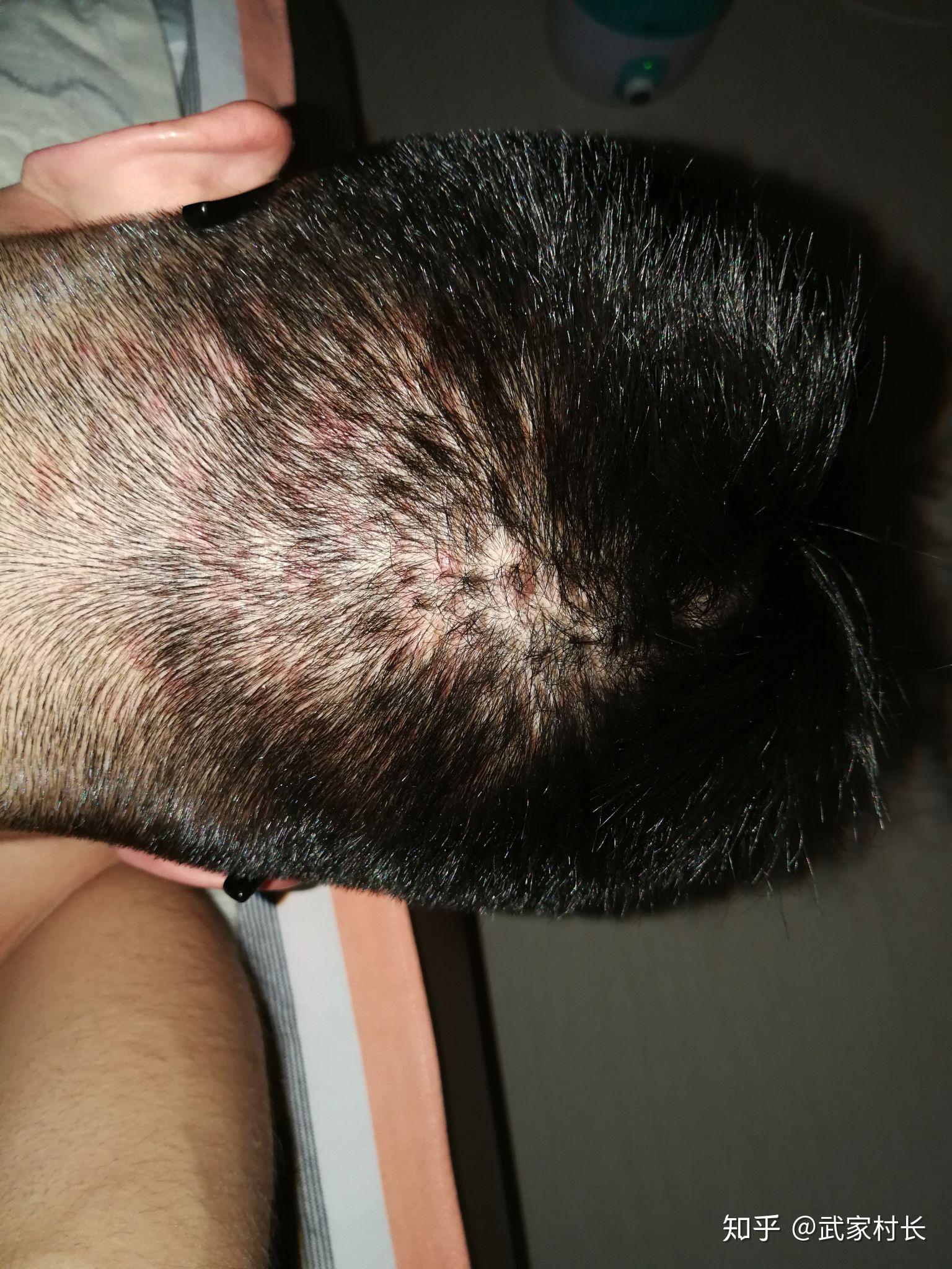 毛囊炎难道是绝症吗