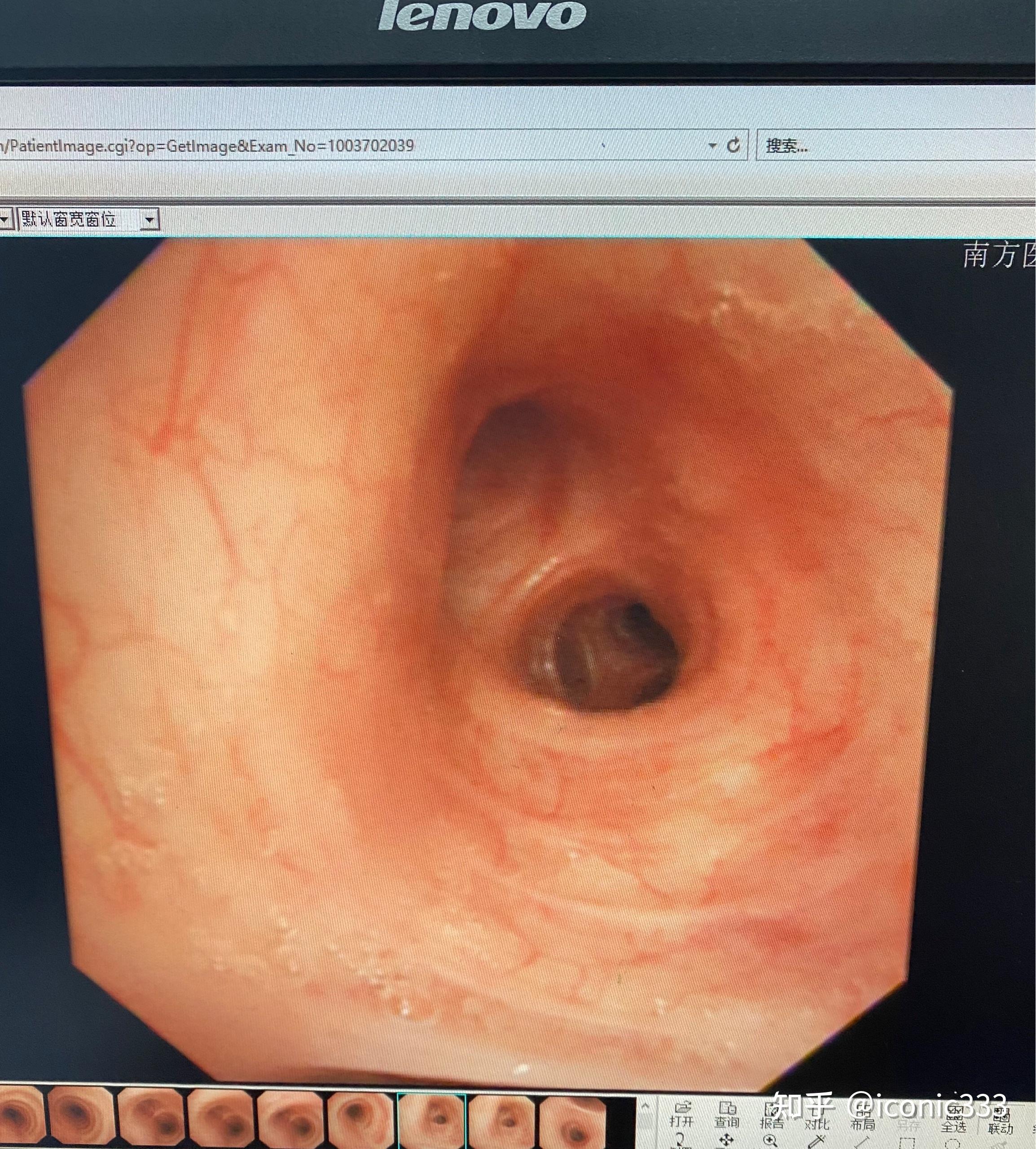 米粒呛入气管会有什么反应如果不取出会有什么后果