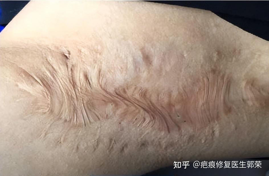烧烫伤疤痕该怎么修复?能修复到什么程度? - 知乎
