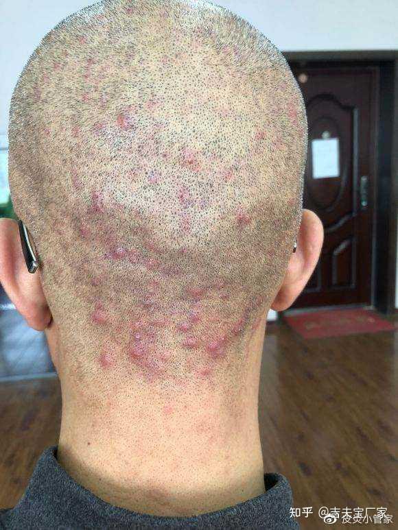 头皮毛囊炎该怎么治疗呢? - 知乎