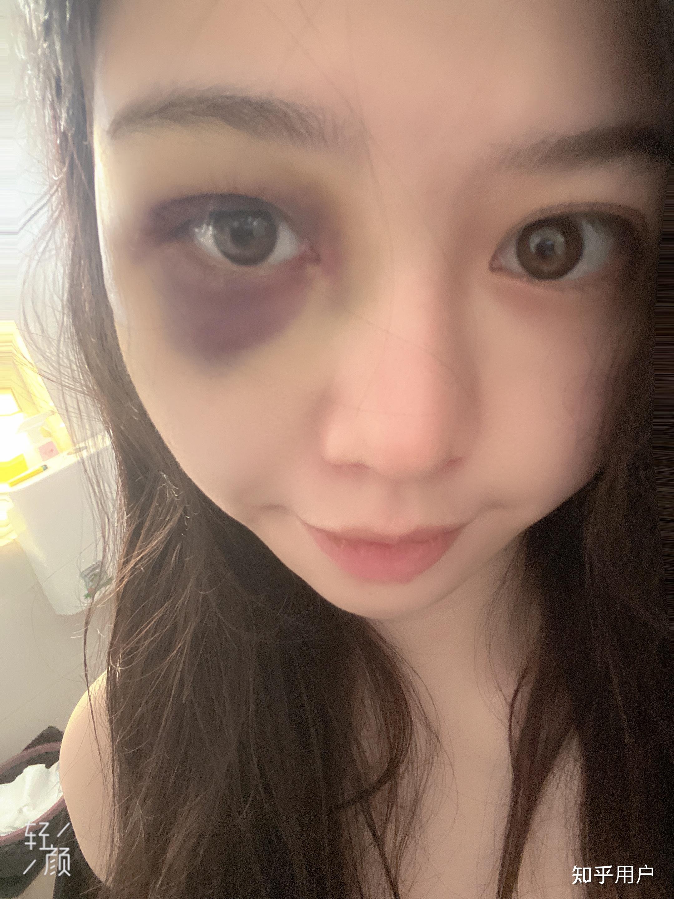 想知道眼部淤青怎么可以快速消除? - 知乎