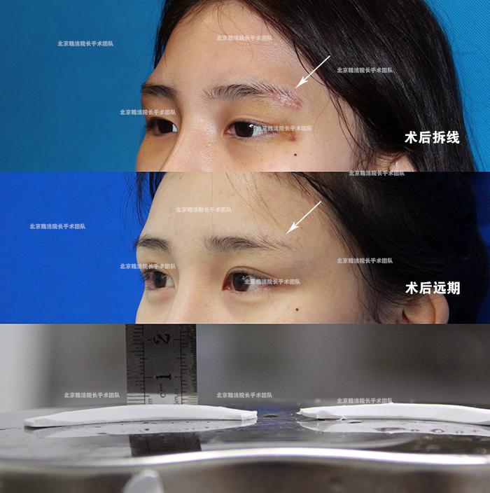 假体垫眉弓的手术切口在哪里?膨体丰眉弓术后会留疤么?瘢痕是否明显 - 知乎