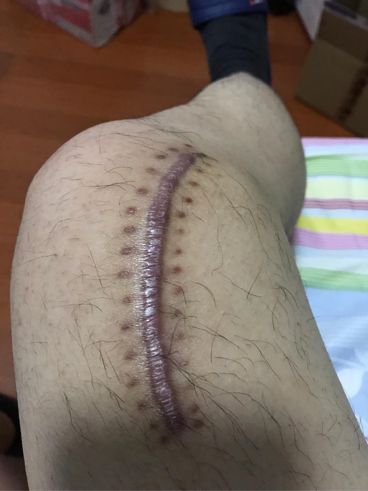 右胫膝盖内侧良性骨软骨瘤对以后有影响吗不手术切除的话