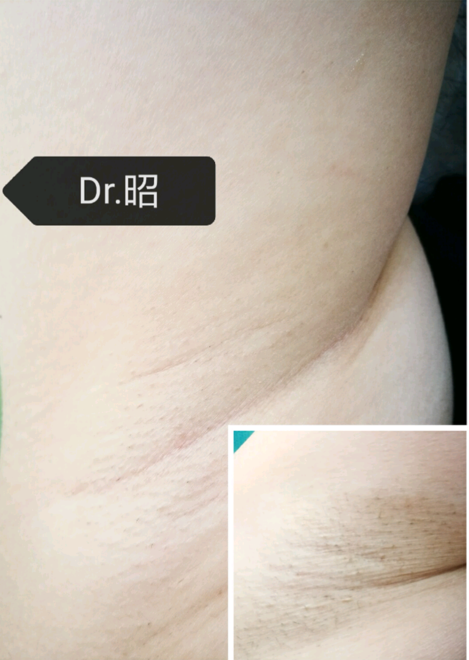 男人有必要做脱毛吗