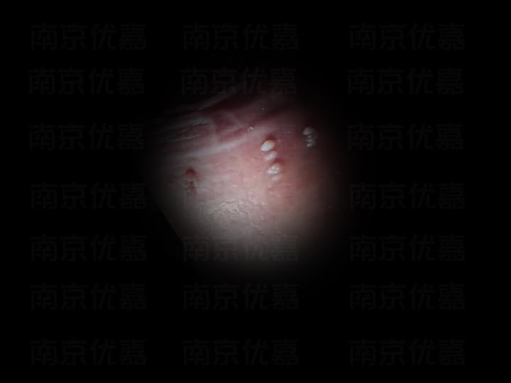 尖锐湿疣的初期症状表现是什么样的? - 知乎
