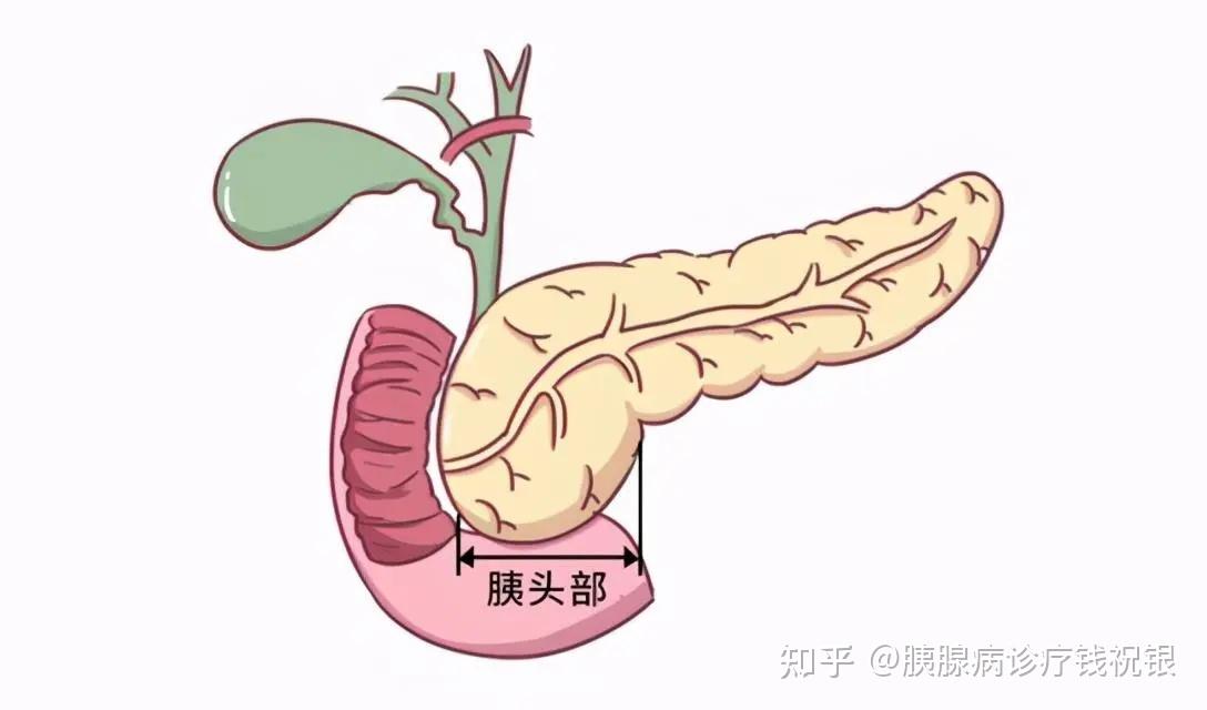 四成胰腺癌患者早期有糖尿病现象 - 知乎