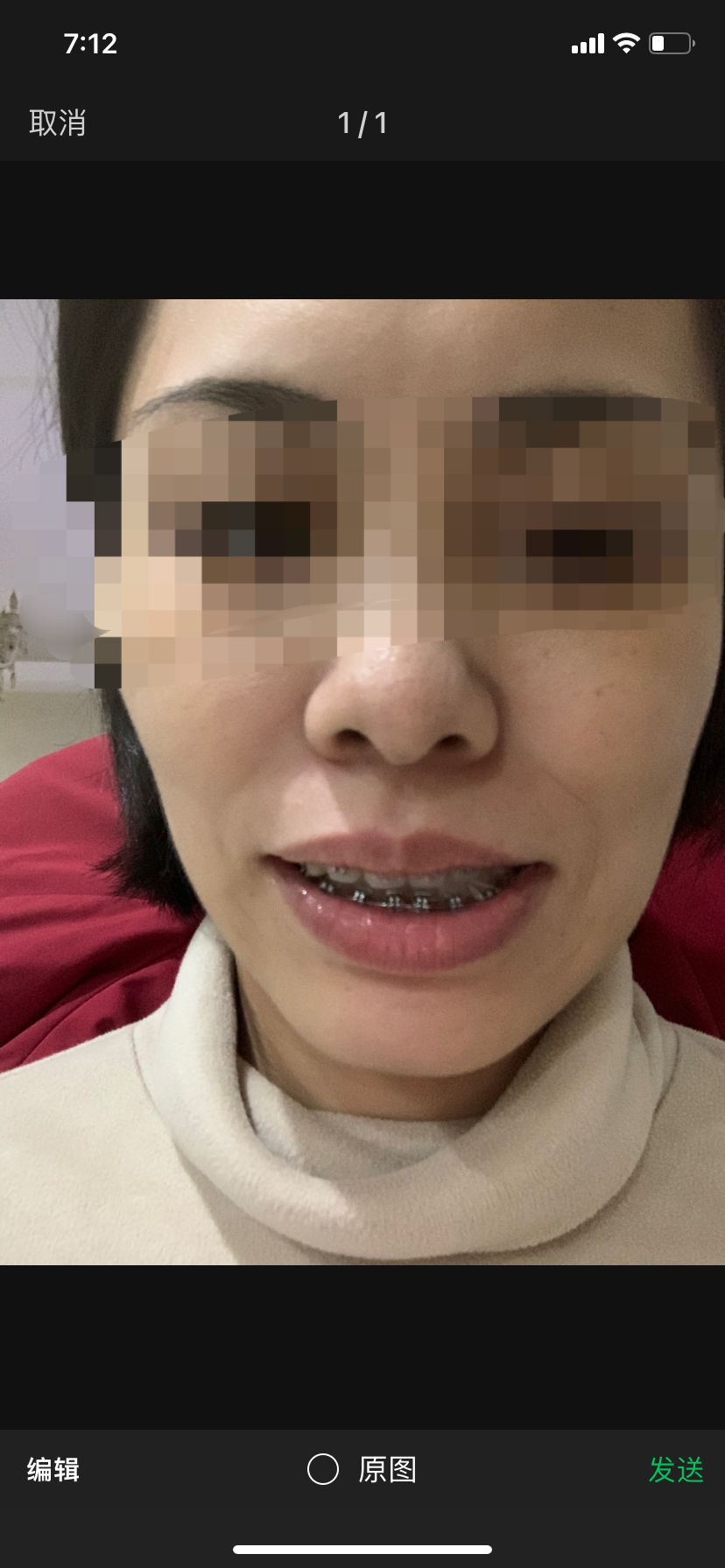 严重偏颌,两位医生给了两套方案,不知道该做怎样的选择? - 知乎