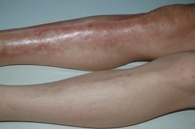 骨结核症状详解