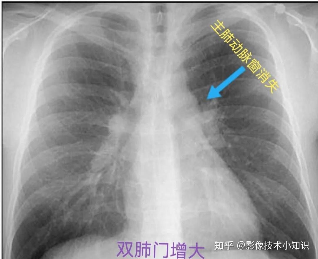 正常的肺门图片大全图片