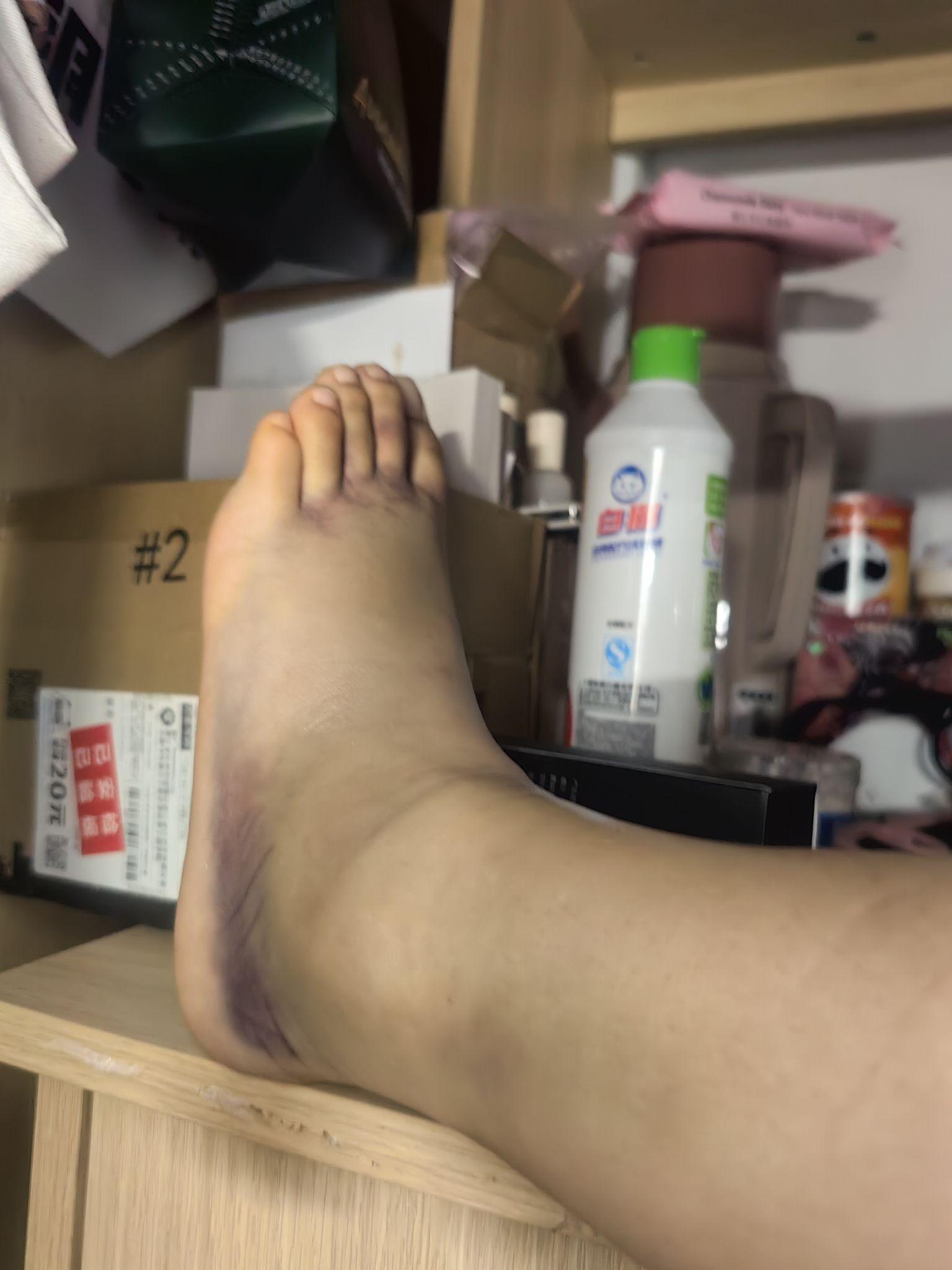 脚崴了没骨折肿很大怎么办?