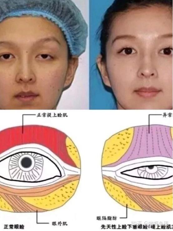 做过双眼皮提肌手术的你们,怎么样了,后悔吗? - 知乎