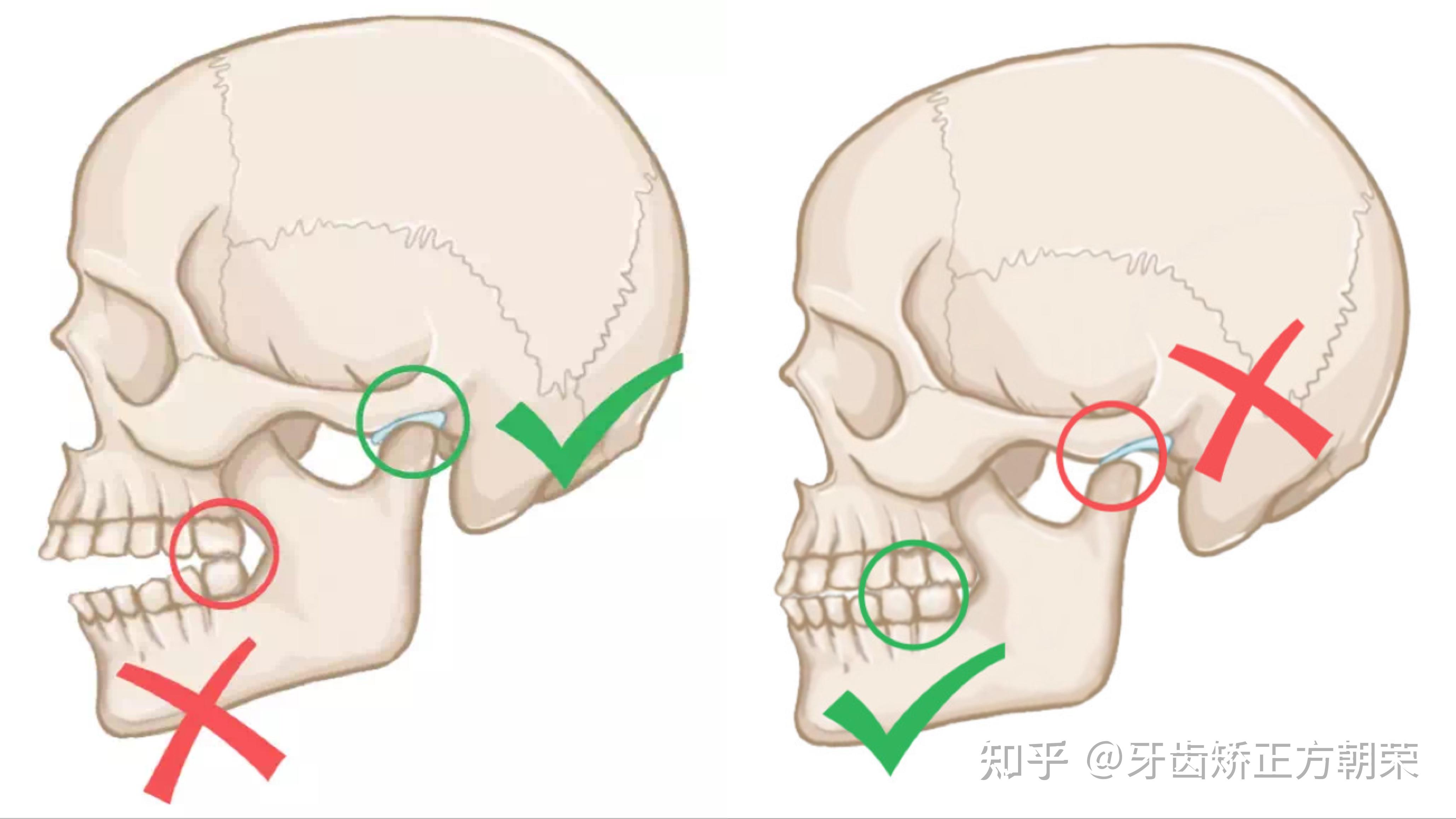 颞下颌关节紊乱治疗好后 必须要矫正牙齿吗? - 知乎