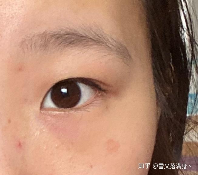 有用过氢醌乳膏祛斑成功的吗?说说呗? - 知乎